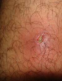 Boils Bumps Skin Infection Symptoms