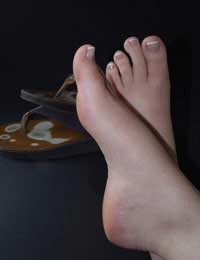 Losing Toenails Nail Bed Feet Toes