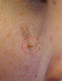 Skin Tags Acrochorda Treatment Removal