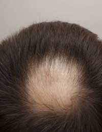 Baldness Male Pattern Baldness Hair Loss
