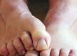 Athlete's Foot