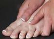 Recognising and Treating Bunions