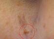 Coping With Excessive Skin Tags