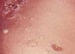 Dealing With Impetigo