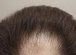 Baldness: What Can I Do About It?