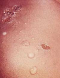 Impetigo; Bacteria; Infection;